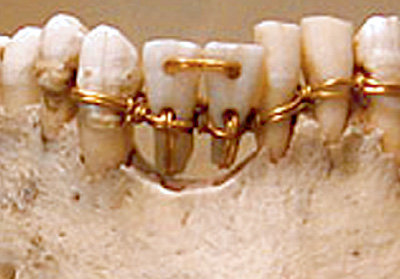Античные протезисты скрепляли зубной ряд золотой проволокой