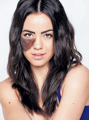 Канадке Кассандре НАУД родимое пятно не помешало в карьере танцовщицы