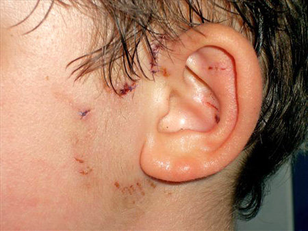 Следы от укуса собаки навсегда останутся на лице ребёнка